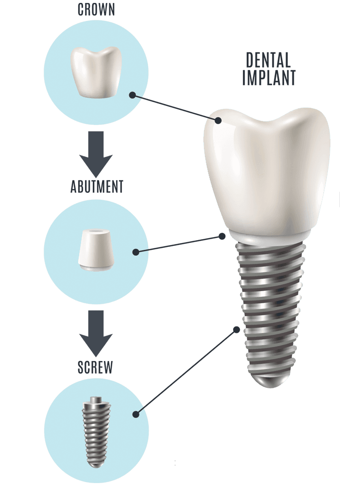 Dental implant anatomy showing titanium root, abutment and crown