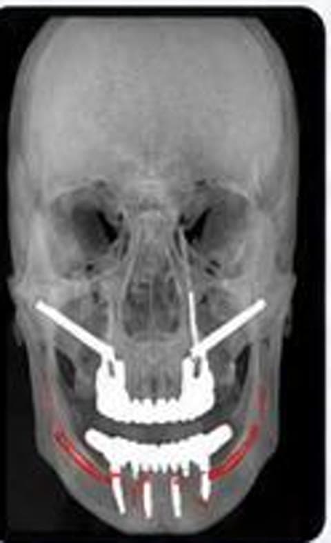 Frontal CT radiology view for implant rehabilitation planning