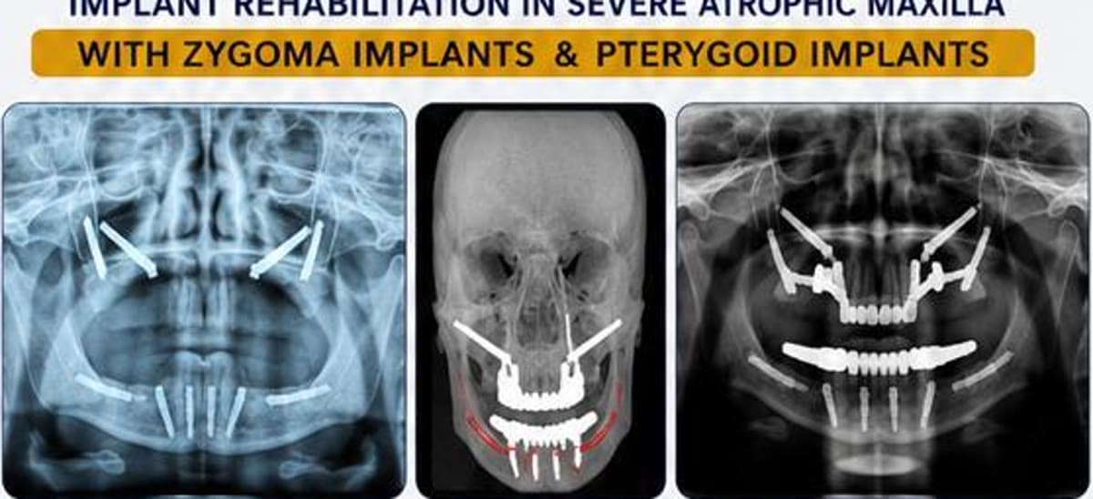 Radiology images showing severe atrophic maxilla rehabilitation with zygoma implants and pterygoid implants