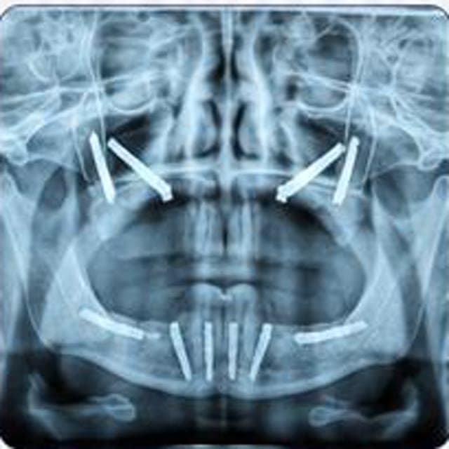 Panoramic radiology view for zygoma and pterygoid implant rehabilitation