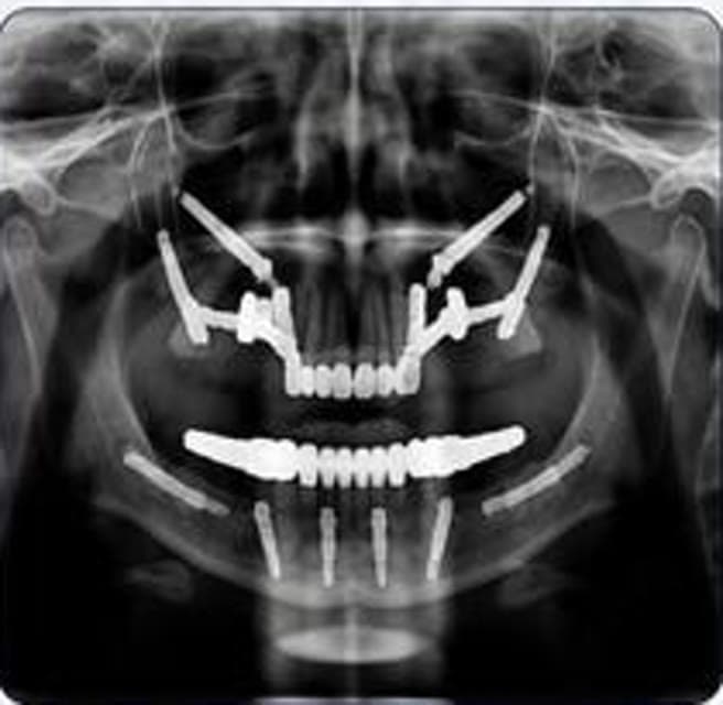 Post implant panoramic radiology view after rehabilitation