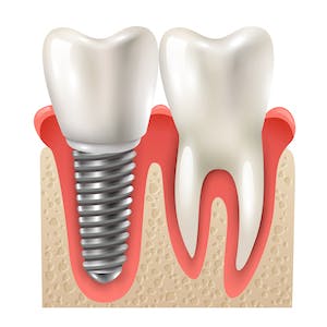 dental_implant_cost