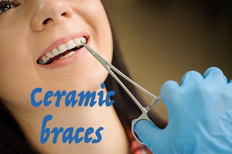Clips and Braces. Orthodontics treatment for irregular teeth. Smile Design