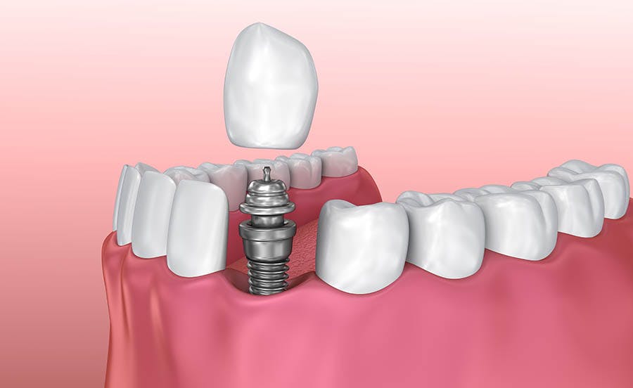 Implant for Fixed teeth in missing tooth area