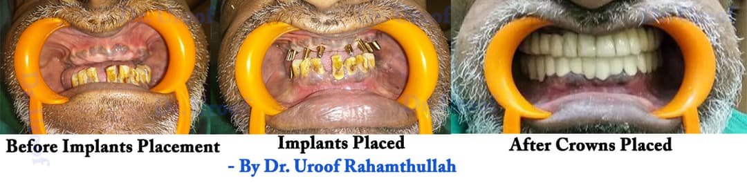Full-arch All-on-X implant restoration before and after