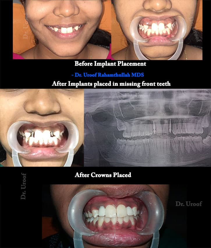 Implants placed in front missing teeth