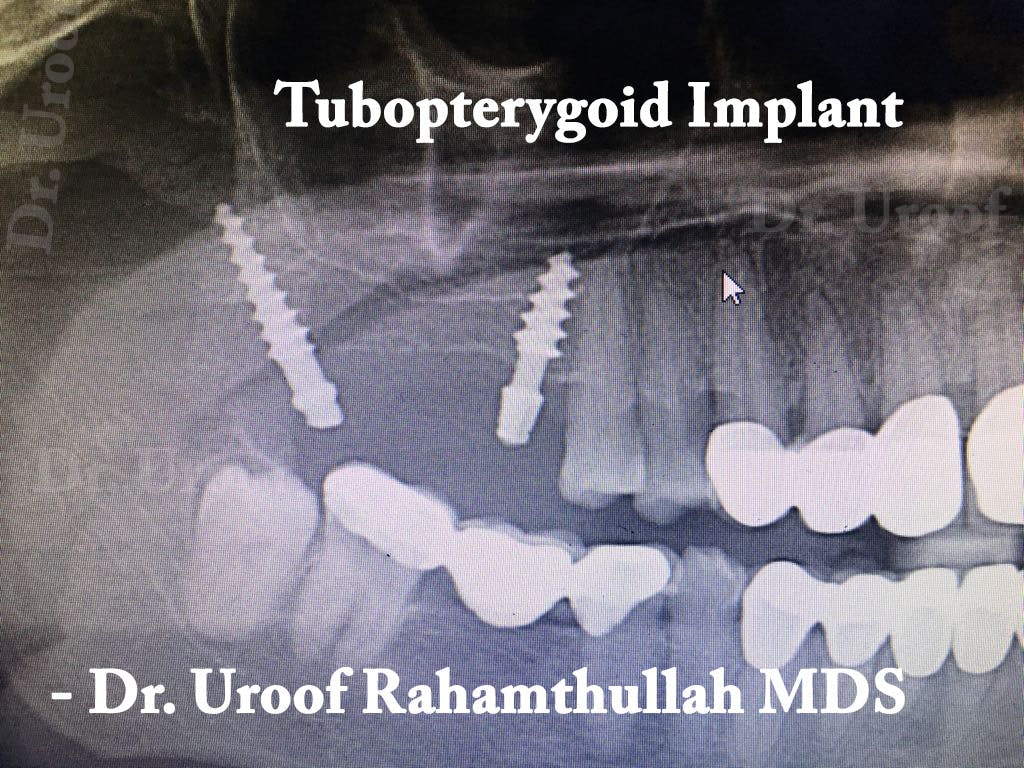 Implants supported Denture placed in upper missing teeth area 