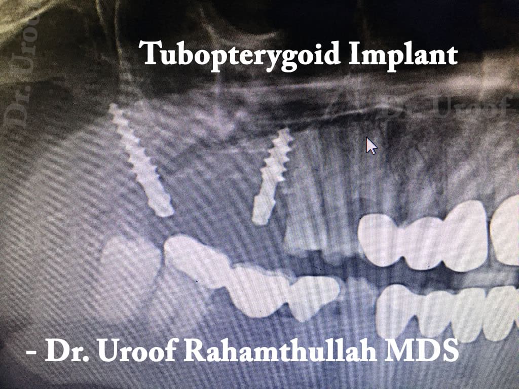 Implants supported Denture placed in upper missing teeth area