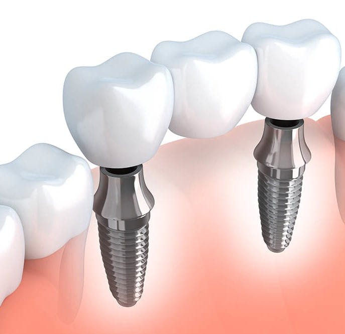 Implant for Fixed teeth in missing tooth area