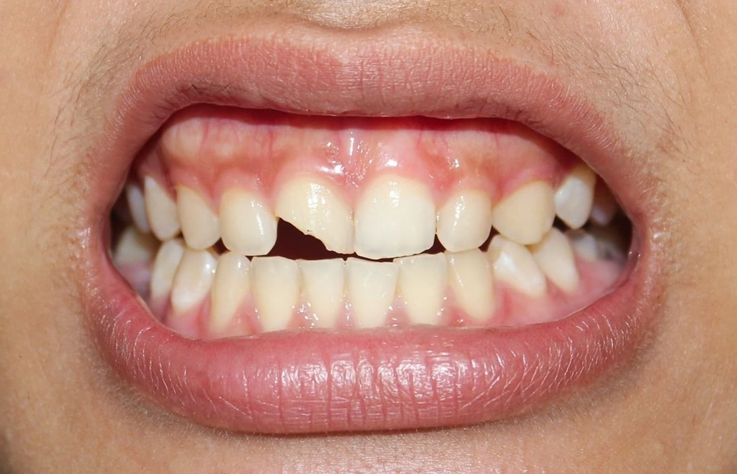 Cracked teeth and chipped edges checked before smile design in Tirupati