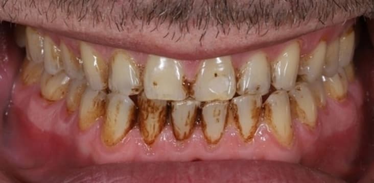 Teeth stains and shade concern before cosmetic dental treatment in Tirupati