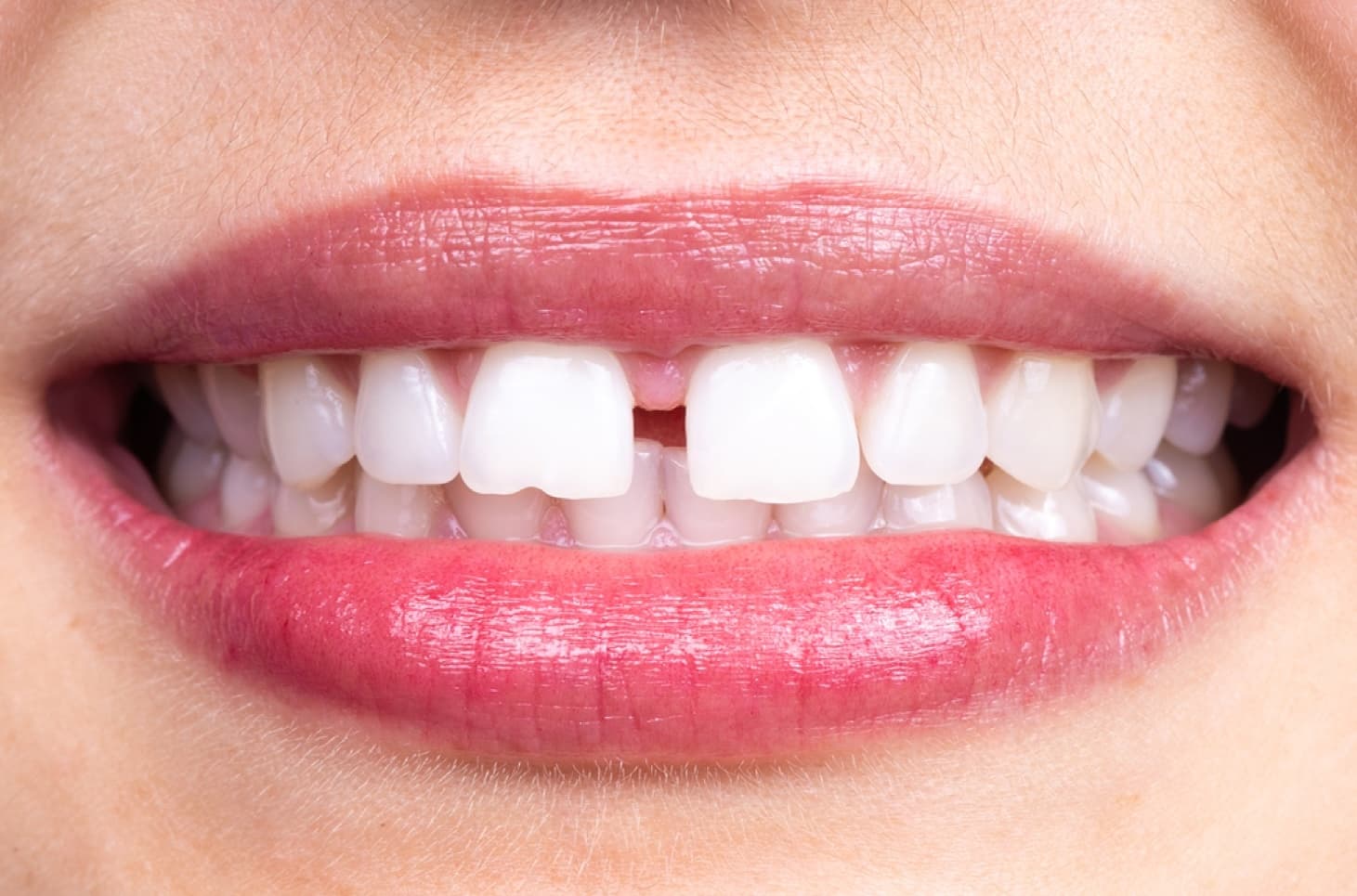 Teeth gaps and spacing concern for smile design consultation in Tirupati